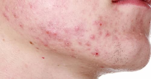 Mụn do demodex triệu chứng thường xuất hiện ở vùng da có nhiều dầu