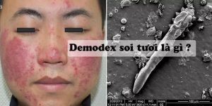 Demodex soi tuoi - Anh bia