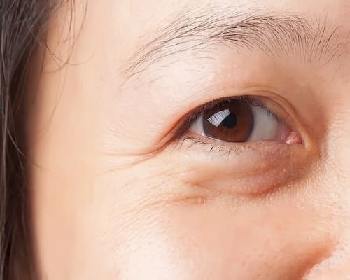 Bọng mắt ngày nay không chỉ phổ biến ở người trung niên mà còn phổ biến ở người trẻ