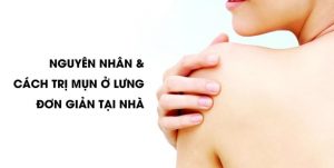 kinh-ngac-voi-cach-tri-mun-lung-don-gian-ma-hieu-qua-hinh-01