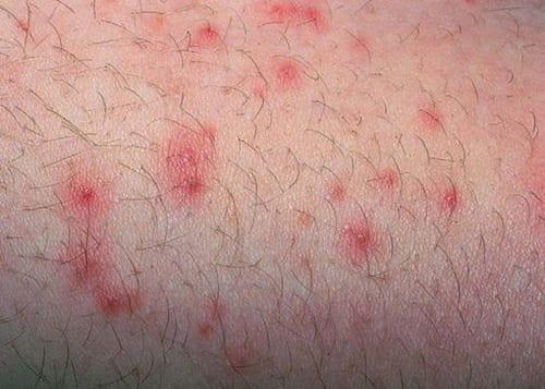 Da nổi mẩn đỏ là dấu hiệu viêm chân lông đầu tiên