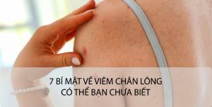 trị viêm nang lông