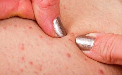 Viêm lỗ chân lông có thể xuất hiện ở tất cả vùng da trên cơ thể