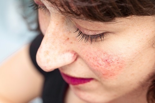 Da mặt bị đỏ và ngứa thường là dấu hiệu chính xác nhất của viêm da demodex và hội chứng đỏ mặt (Rosacea)