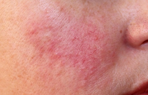 Chứng đỏ mặt hay còn gọi là bệnh rosacea