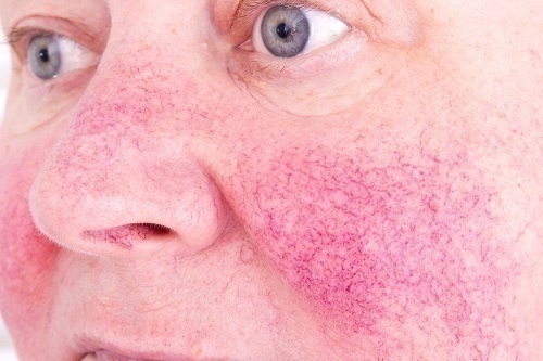 Giãn mao mạch thường xuất hiện ở giai đoạn 4 của bệnh đỏ da mặt
