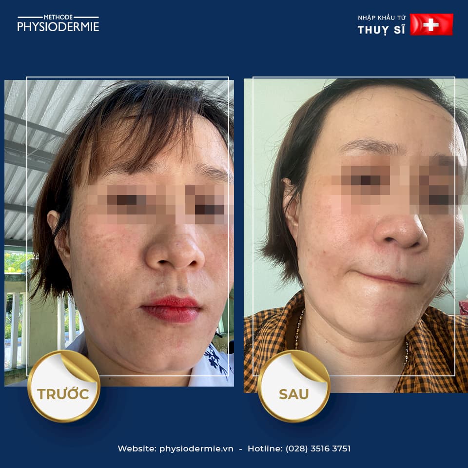 Chị T (40T) – Điều trị nám, xạm da chỉ trong 2 tháng sử dụng sản phẩm