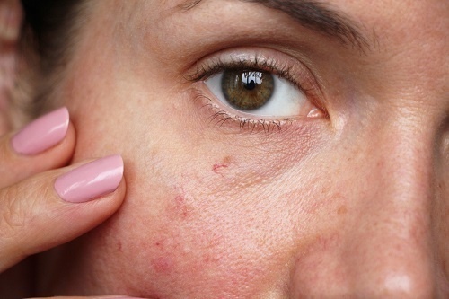Da nhạy cảm là một trong những nguyên nhân đầu tiên của các vấn đề da khác, đặc biệt là dị ứng đỏ ngứa.
