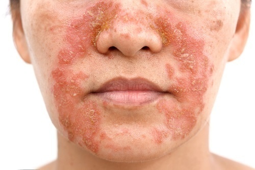 Các tảng da sần sùi do chàm Eczema