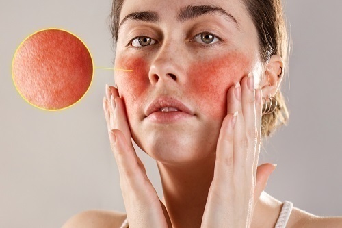 Bệnh đỏ da mặt thường xuất hiện ở lứa tuổi 30 đến 50, nữ nhiều hơn ở nam