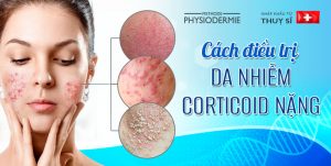 cach-dieu-tri-da-bi-nhiem-corticoid-thumbnail