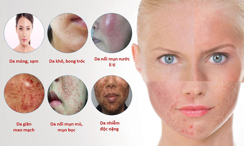 Các biểu hiện của da mặt bị nhiễm corticoid