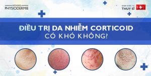 điều trị corticoid