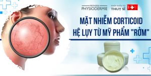 mặt bị nhiễm corticoid