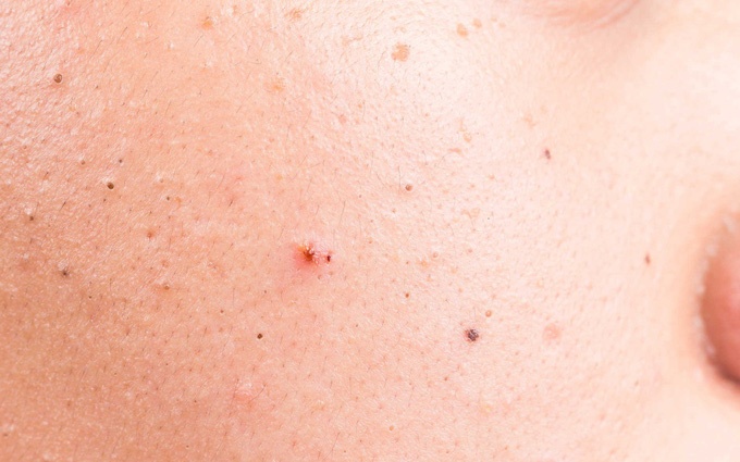 Bệnh viêm nang lông ở da mặt.