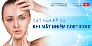 mặt nhiễm corticoid