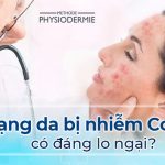 Tình trạng da bị nhiễm corticoid có đáng lo ngại?
