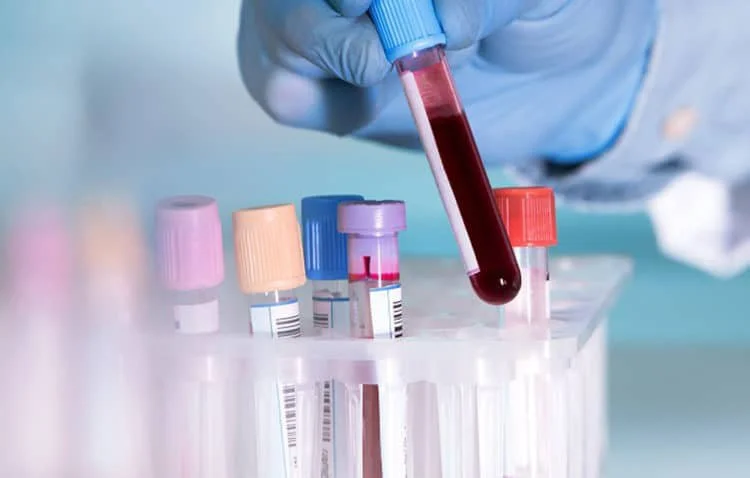 Cách chẩn đoán khoa học nhất để biết được cơ thể có bị nhiễm chì hay không là thực hiện xét nghiệm máu