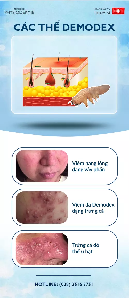 Các thể bệnh viêm da do demodex