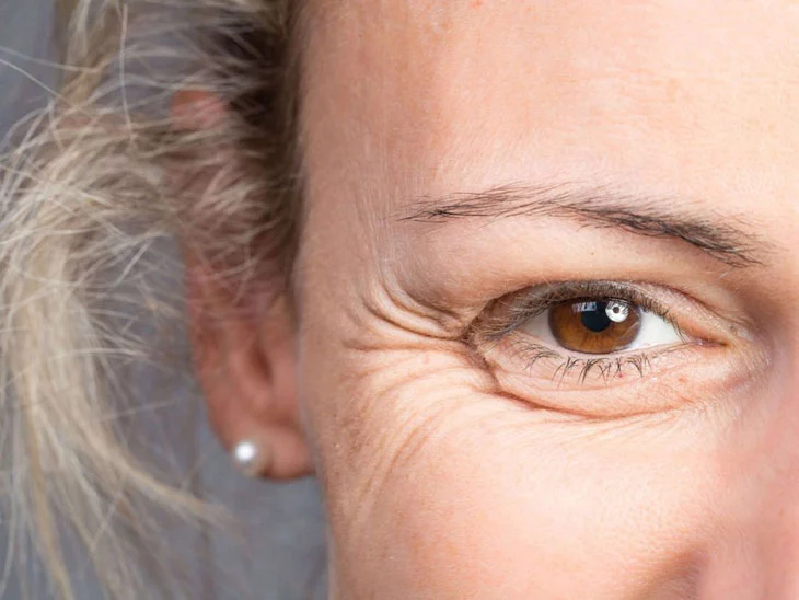 Nếp nhăn là một trong những dấu hiệu lão hóa da mặt dễ nhận biết